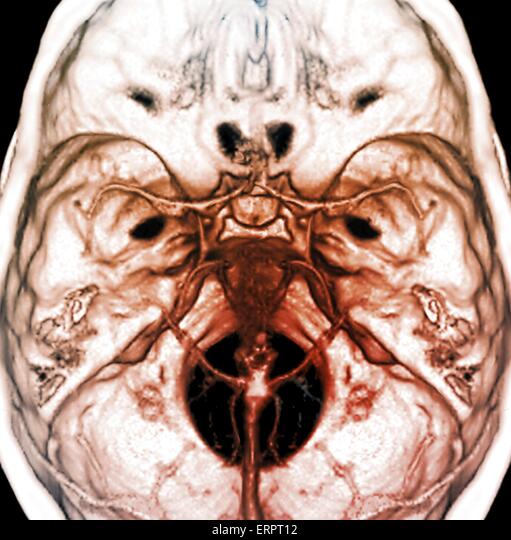 Angiotomografía cerebral